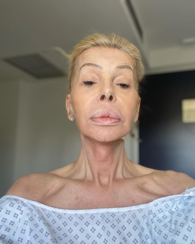 Bibiana Fernández tras su operación con esparadrapos en las orejas